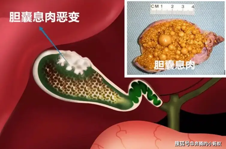 年龄小切除胆囊有什么副作用_切除年龄胆囊小怎么办_胆囊切除最小的年龄